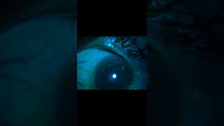 Filamentary keratitis corneal filaments mucoepitheliod strands shorts trending reels [upl. by Oconnor473]