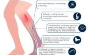 common peroneal nerve disorder and its physiotherapy treatment [upl. by Adnuhsor]