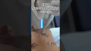 EXFU Nanosecond laser whiteningcarbon whiteningexfulaser [upl. by Norramic]