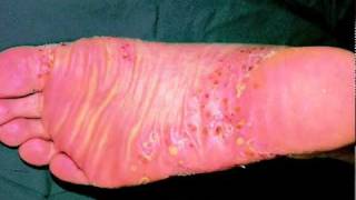 Types of Psoriasis  An Overview [upl. by Tolliver]