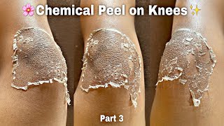 Chemical Peel on Knees Part 3 TCA peel at home 25 TCA Chemical peel chemicalpeel tcapeel [upl. by Airahs129]