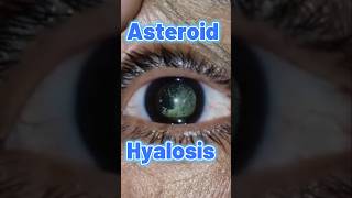 ASTEROID HYALOSIS [upl. by Libbi578]