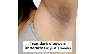 Dark Neck amp Underarms Treatment  Treat Acanthosis Nigricans [upl. by Mages282]