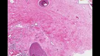 Histopathology SkinLichen sclerosus et atrophicus [upl. by Natsirhc]