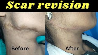 Ideal result after scar revision surgery scar revision surgery Result after 3 month scarrevision [upl. by Gagliano]