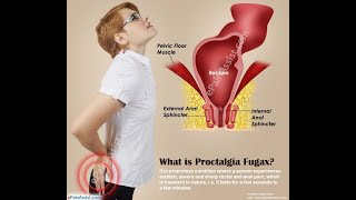 Proctalgia FUGAX 🔴ألم المستقيم العابر [upl. by Jeri]