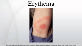 Erythema [upl. by Meelak]