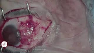 Live surgery of pterygium removal with graft from Elpis Medical Centre [upl. by Margaretha]