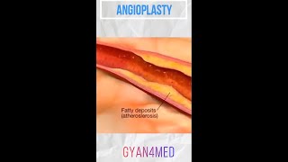 Coronary angioplasty Femoral Access [upl. by Marylee339]