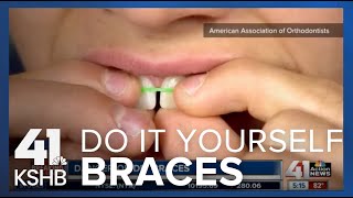 DIY Braces [upl. by Ardnasak]