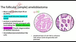 Ameloblastoma HISTOPATHOLOGYtypesRadiographic featuresclinical featuresOdontogenic tumors [upl. by Beesley]