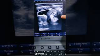 intussusception by ultrasound and evaluation تشخيص وشرح الحاله مباشر من العياده [upl. by Ripp]