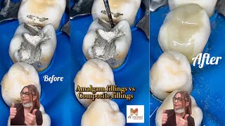 Amalgam Fillings VS Composite Fillings [upl. by Auqinom924]