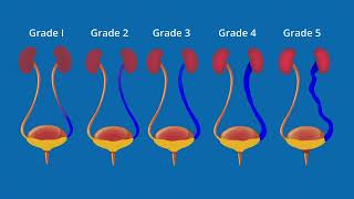 What is Vesicoureteral Reflux VUR [upl. by Reyaht540]