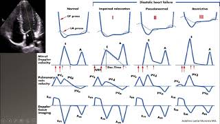 diastolic dysfunction part IIgrading ASE 2016 [upl. by Noisla]