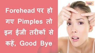 Get Rid of Forehead Pimples with these Easy Ways Hindi [upl. by Anoy]