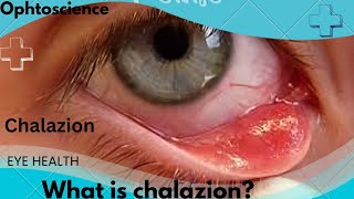 What is chalazion  what causedchalazion  Is chalazion a stye [upl. by Ahsened]