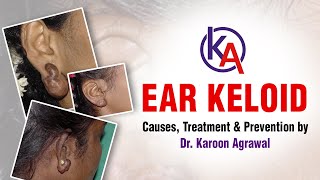 जानिए Ear Keloid के बारे में  Keloid on EarPiercing  Causes treatment amp prevention by Dr Karoon [upl. by Nerrot]