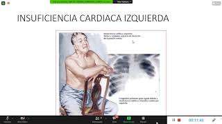 Semiología de insuficiencia cardiaca [upl. by Zimmermann]