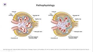 LongTerm Effects of Empagliflozin in CKD Insights from EMPAKIDNEY Trial By Dr  Nouran M Anwar [upl. by Hum]