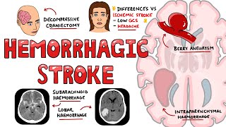 Hemorrhagic Stroke  Intracerebral Hemorrhage amp Subarachnoid Hemorrhage  Management [upl. by Nnywg]