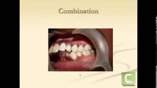 Classification of malocclusion [upl. by Frisse601]