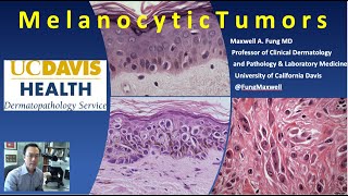 DERMATOPATHOLOGY Melanocytic Tumors [upl. by Jacklyn]