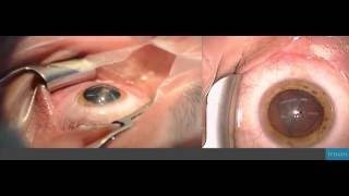 Refractive lens exchange with multifocal lens implantation [upl. by Anwadal]