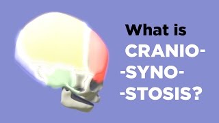 What is Craniosynostosis [upl. by Goldfarb]