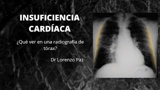 Insuficiencia cardíaca  Hallazgos radiográficos Falla cardíaca [upl. by Otilegna]