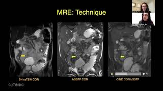 CT Versus MR Enterography PointCounterpoint [upl. by Davy]