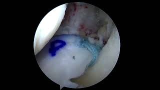 Trasplante meniscal y condral [upl. by Mayeda]