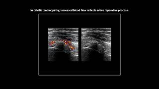 Supraspinatus calcific tendinopathy and increased vascularity on Doppler ultrasound [upl. by Elmer]