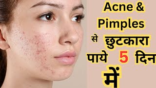 कील मुहासो acne की दवा Clindamycin phosphate gel  usesmechanism of action  Clinsol Gel review [upl. by Philo970]