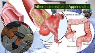 Atherosclerosis and Appendicitis medical pathology nursing [upl. by Bork]