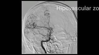 Brain tumor right position Angiography confirmation [upl. by Zorina]