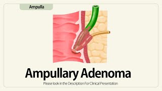 Ampullary Adenoma [upl. by Camm]