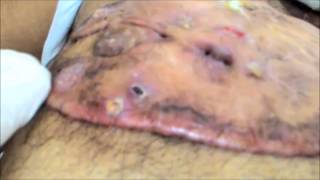 A Big Keloid covering entire chest with ulceration Chronic Keloid Hypertrophic scar क्षतांक [upl. by Erma]