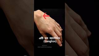 গ্যাংলিয়ন Ganglion এর চিকিৎসা বিনা অপারেশনে ganglion treatment withoutsurgery health shorts [upl. by Pattie]