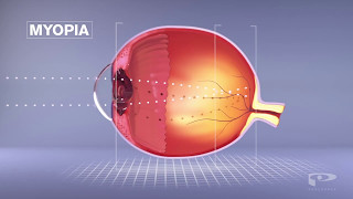 EyeDream Advanced Orthok  What is Ortho k [upl. by Nesline]