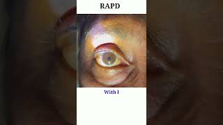 RAPD testing  Optic nerve test  Swinging flash light test eyecareoptom shorts rapd short eye [upl. by Dorweiler]