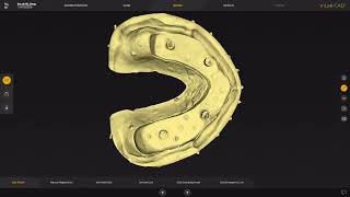 Steg design in de inLab 22 software [upl. by Meredeth]