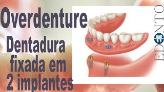 Overdenture prótese total fixa por dois implantes [upl. by Hemphill]