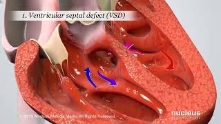 Blue Baby Heart Defect Tetralogy of Fallot [upl. by Hairu555]