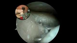 chondrotissue® arthroscopic fixation with fibrin glue [upl. by Bodi510]