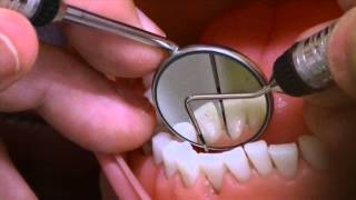 Probe Lingual Mandibular Anteriors [upl. by Anaed]