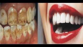 TEETH WHITENING AND TIPS ON HOW TO TAKE CARE OF YOUR TEETH [upl. by Nairbo311]