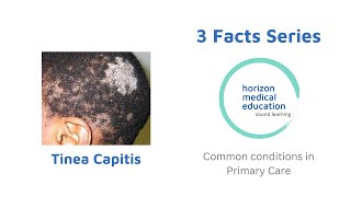 Scalp ringworm Tinea capitis  Fungal infection [upl. by Alleras33]