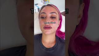 Natural Lip Filler Results  Juvederm Ultra Plus  Book Lip Filler Today [upl. by Iv185]