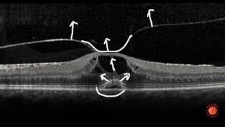 OCT Interpretation  Vitreous [upl. by Inaoj]